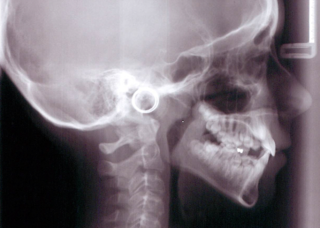 The Second Molar Dilemma Donna Stenberg The Second Molar Dilemma Figure 1
