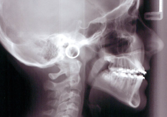 The Second Molar Dilemma Donna Stenberg The Second Molar Dilemma Figure 2