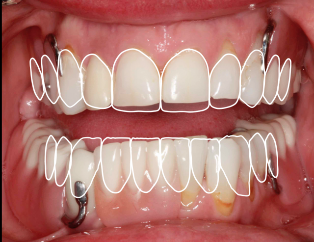 A Step-by-Step Guide to Converting Denture to Interim Hybrid Prosthesis Doug Benting Converting Denture to Interim Hybrid Prosthesis fig. 1