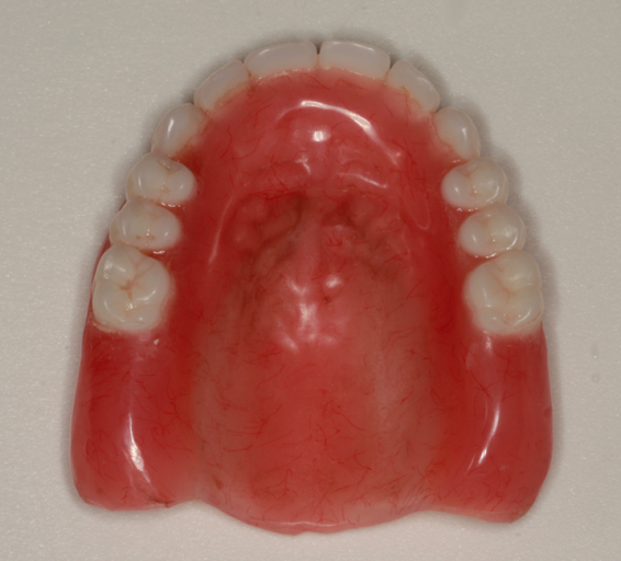A Step-by-Step Guide to Converting Denture to Interim Hybrid Prosthesis Doug Benting Converting Denture to Interim Hybrid Prosthesis fig. 2