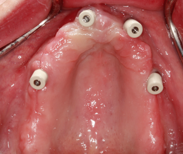 A Step-by-Step Guide to Converting Denture to Interim Hybrid Prosthesis Doug Benting Converting Denture to Interim Hybrid Prosthesis fig. 3