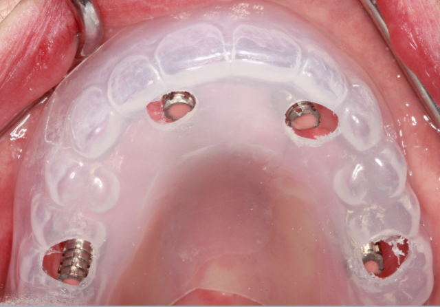 A Step-by-Step Guide to Converting Denture to Interim Hybrid Prosthesis Doug Benting Converting Denture to Interim Hybrid Prosthesis fig. 4