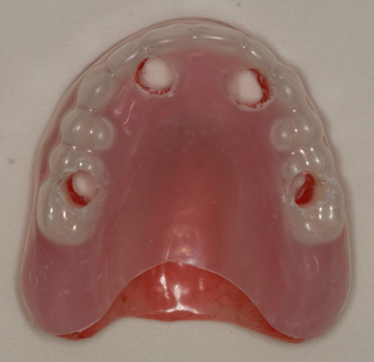 A Step-by-Step Guide to Converting Denture to Interim Hybrid Prosthesis Doug Benting Converting Denture to Interim Hybrid Prosthesis fig. 5