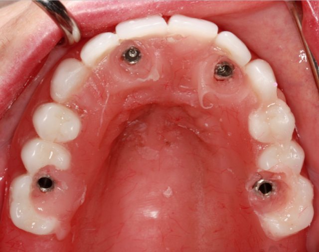 A Step-by-Step Guide to Converting Denture to Interim Hybrid Prosthesis Doug Benting Converting Denture to Interim Hybrid Prosthesis fig. 6