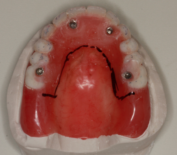 A Step-by-Step Guide to Converting Denture to Interim Hybrid Prosthesis Doug Benting Converting Denture to Interim Hybrid Prosthesis fig. 7