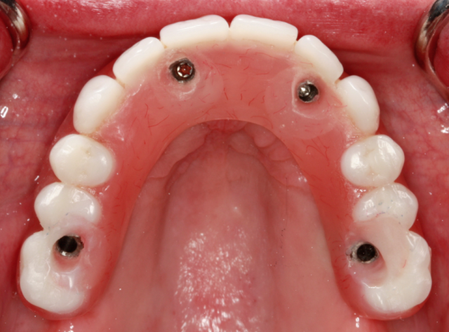 A Step-by-Step Guide to Converting Denture to Interim Hybrid Prosthesis Doug Benting Converting Denture to Interim Hybrid Prosthesis fig. 8