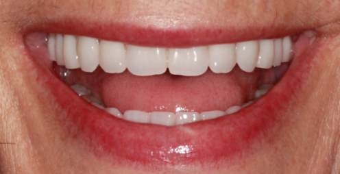 A Step-by-Step Guide to Converting Denture to Interim Hybrid Prosthesis Doug Benting Converting Denture to Interim Hybrid Prosthesis fig. 9