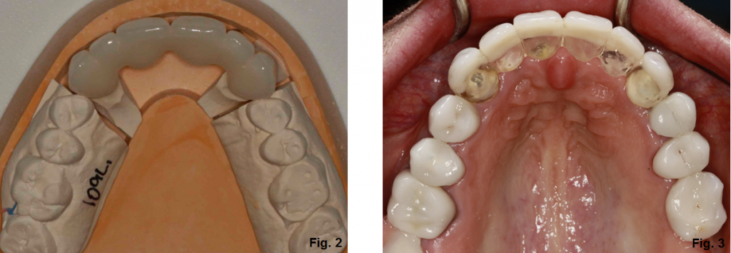 Tooth Supported Fixed Bridge for Missing Maxillary Incisors Doug Benting Tooth Supported Fixed Bridge Figure 2 3