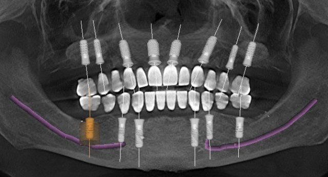 How Many Implants in the Edentulous Maxilla? - Spear Education