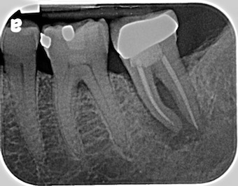 Implant-Supported Restoration for a Lower Second Molar DougBentig implant supported restoration for a lower second molar Fig.1