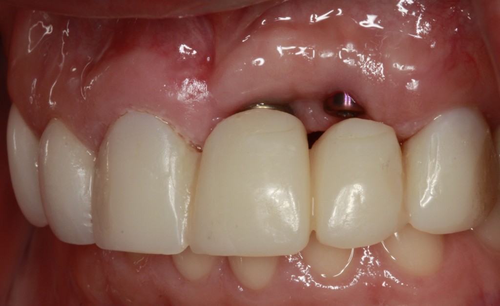 Implant Supported Fixed Bridge for Maxillary Incisors DougBenting implant supported fixed bridge FeaturedImage