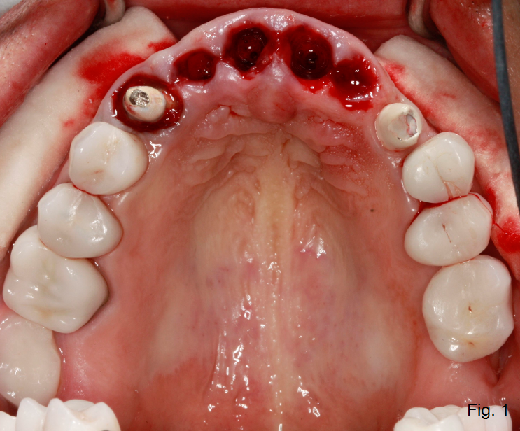 Implant Supported Fixed Bridge for Maxillary Incisors DougBenting implant supported fixed bridge Fig.1