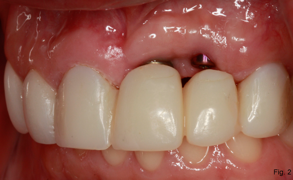 Implant Supported Fixed Bridge for Maxillary Incisors DougBenting implant supported fixed bridge Fig.2
