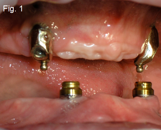 Maxillary Prosthesis Retained by Two Dental Implants DougBenting maxillary prosthesis retained by two dental implants Fig.1