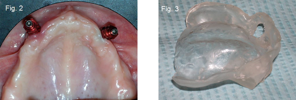 Maxillary Prosthesis Retained by Two Dental Implants DougBenting maxillary prosthesis retained by two dental implants Fig.2 3