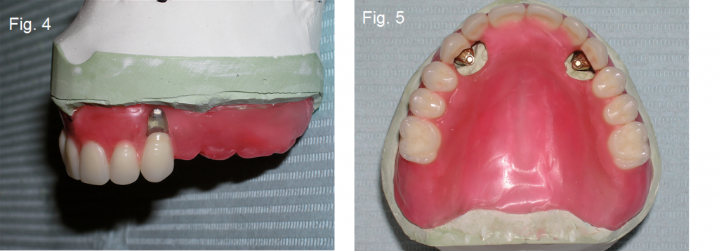 Maxillary Prosthesis Retained by Two Dental Implants DougBenting maxillary prosthesis retained by two dental implants Fig.4 5
