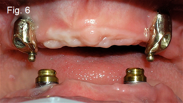 Maxillary Prosthesis Retained by Two Dental Implants DougBenting maxillary prosthesis retained by two dental implants Fig.6