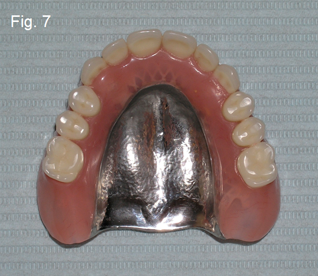 Maxillary Prosthesis Retained by Two Dental Implants DougBenting maxillary prosthesis retained by two dental implants Fig.7