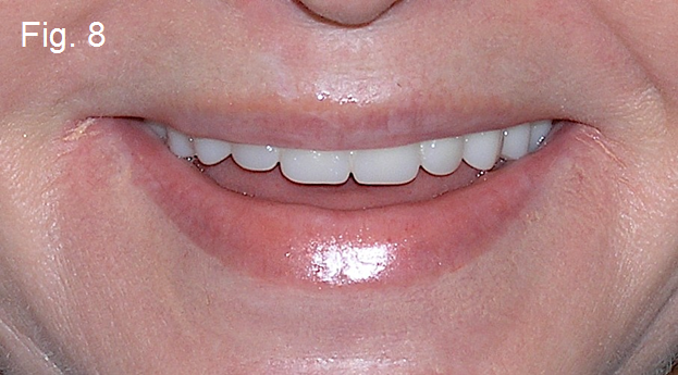 Maxillary Prosthesis Retained by Two Dental Implants DougBenting maxillary prosthesis retained by two dental implants Fig.8