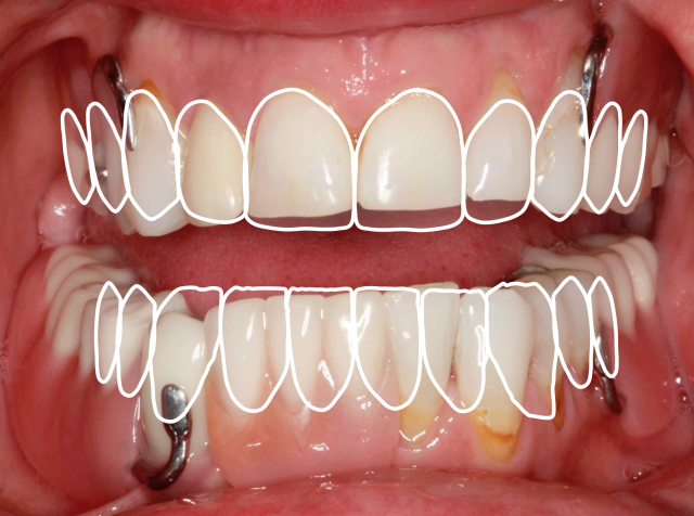 The 3 Best Times To Use Sectional Impression Techniques DougBenting step by step guide to 3 sectional impression techniques Fig.1