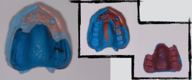 The 3 Best Times To Use Sectional Impression Techniques DougBenting step by step guide to 3 sectional impression techniques Fig.2