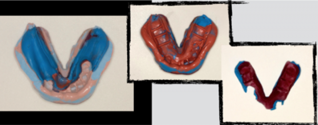 The 3 Best Times To Use Sectional Impression Techniques DougBenting step by step guide to 3 sectional impression techniques Fig.2A