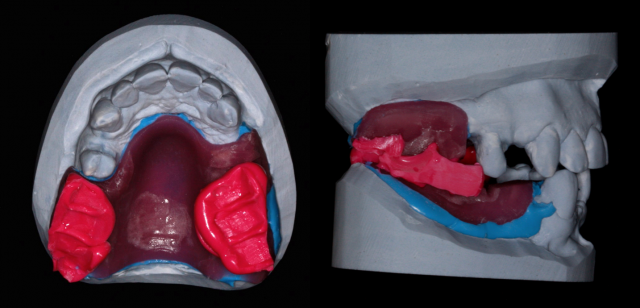 The 3 Best Times To Use Sectional Impression Techniques DougBenting step by step guide to 3 sectional impression techniques Fig.3