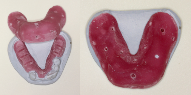 The 3 Best Times To Use Sectional Impression Techniques DougBenting step by step guide to 3 sectional impression techniques Fig.4