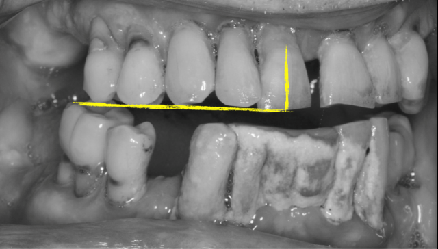 The 3 Best Times To Use Sectional Impression Techniques DougBenting step by step guide to 3 sectional impression techniques Fig.5