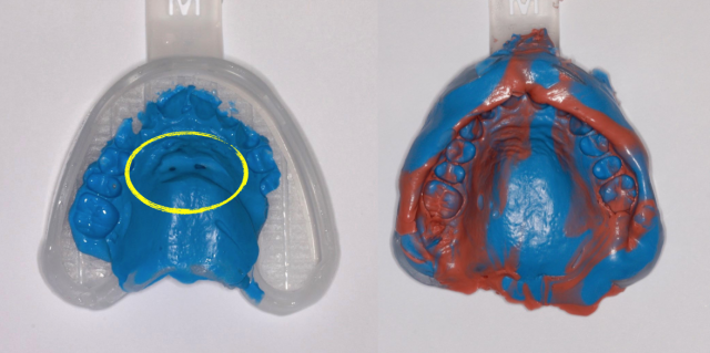 The 3 Best Times To Use Sectional Impression Techniques DougBenting step by step guide to 3 sectional impression techniques Fig.6