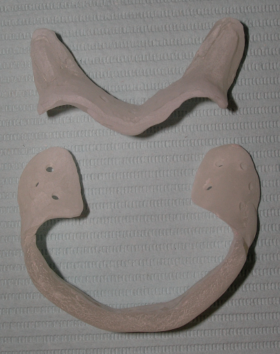 The 3 Best Times To Use Sectional Impression Techniques DougBenting step by step guide to 3 sectional impression techniques Fig.7