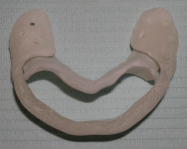 The 3 Best Times To Use Sectional Impression Techniques DougBenting step by step guide to 3 sectional impression techniques Fig.8