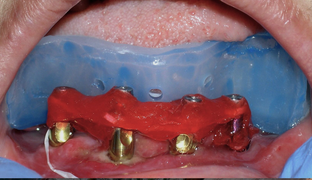 The 3 Best Times To Use Sectional Impression Techniques DougBenting step by step guide to 3 sectional impression techniques Fig.9