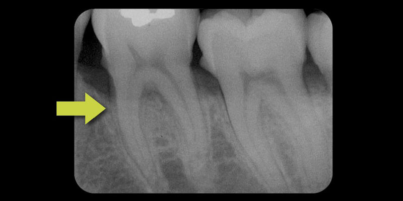 Modern Periodontal Regeneration: Advances in Tissue Engineering for Improved Clinical Outcomes EToddScheyer modern periodontal regeneration advances in tissue engineering for improved clinical outcomes Fig.2A