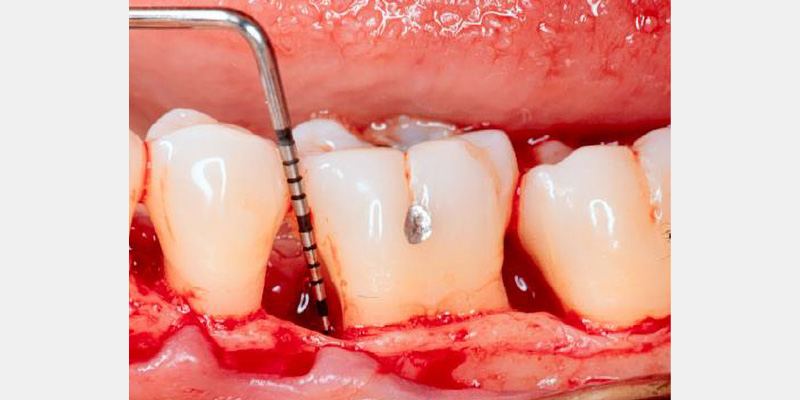 Modern Periodontal Regeneration: Advances in Tissue Engineering for Improved Clinical Outcomes EToddScheyer modern periodontal regeneration advances in tissue engineering for improved clinical outcomes Fig.2b