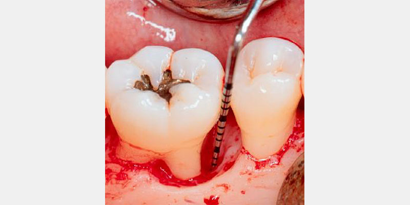 Modern Periodontal Regeneration: Advances in Tissue Engineering for Improved Clinical Outcomes EToddScheyer modern periodontal regeneration advances in tissue engineering for improved clinical outcomes Fig.2c