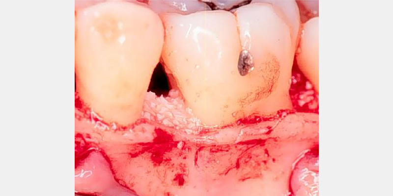 Modern Periodontal Regeneration: Advances in Tissue Engineering for Improved Clinical Outcomes EToddScheyer modern periodontal regeneration advances in tissue engineering for improved clinical outcomes Fig.2d
