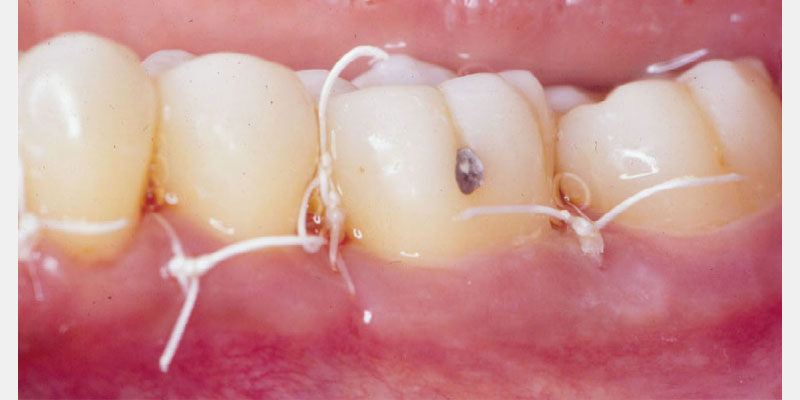 Modern Periodontal Regeneration: Advances in Tissue Engineering for Improved Clinical Outcomes EToddScheyer modern periodontal regeneration advances in tissue engineering for improved clinical outcomes Fig.2e