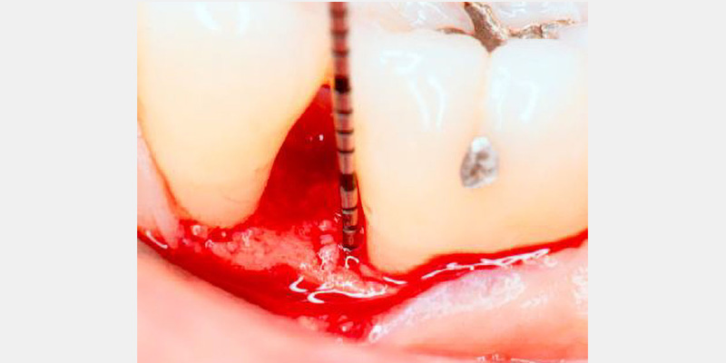 Modern Periodontal Regeneration: Advances in Tissue Engineering for Improved Clinical Outcomes EToddScheyer modern periodontal regeneration advances in tissue engineering for improved clinical outcomes Fig.2f