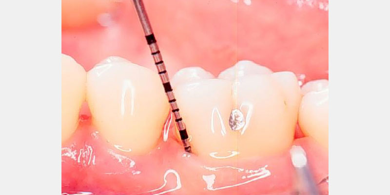 Modern Periodontal Regeneration: Advances in Tissue Engineering for Improved Clinical Outcomes EToddScheyer modern periodontal regeneration advances in tissue engineering for improved clinical outcomes Fig.2g 2