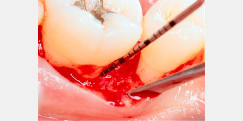 Modern Periodontal Regeneration: Advances in Tissue Engineering for Improved Clinical Outcomes EToddScheyer modern periodontal regeneration advances in tissue engineering for improved clinical outcomes Fig.2h