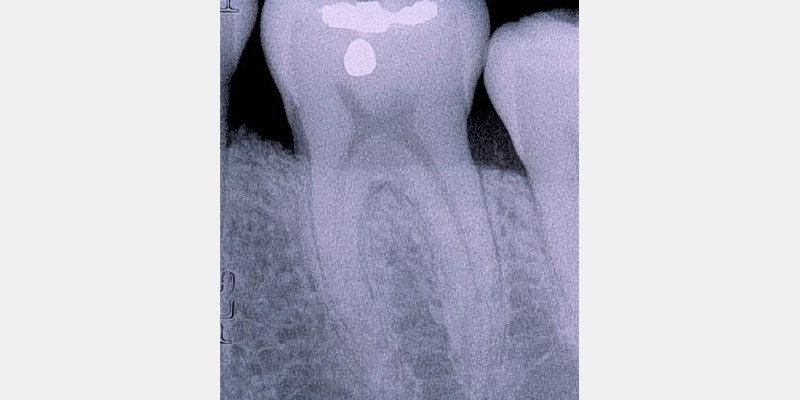 Modern Periodontal Regeneration: Advances in Tissue Engineering for Improved Clinical Outcomes EToddScheyer modern periodontal regeneration advances in tissue engineering for improved clinical outcomes Fig.2i