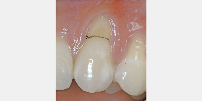 Modern Periodontal Regeneration: Advances in Tissue Engineering for Improved Clinical Outcomes EToddScheyer modern periodontal regeneration advances in tissue engineering for improved clinical outcomes Fig.3a