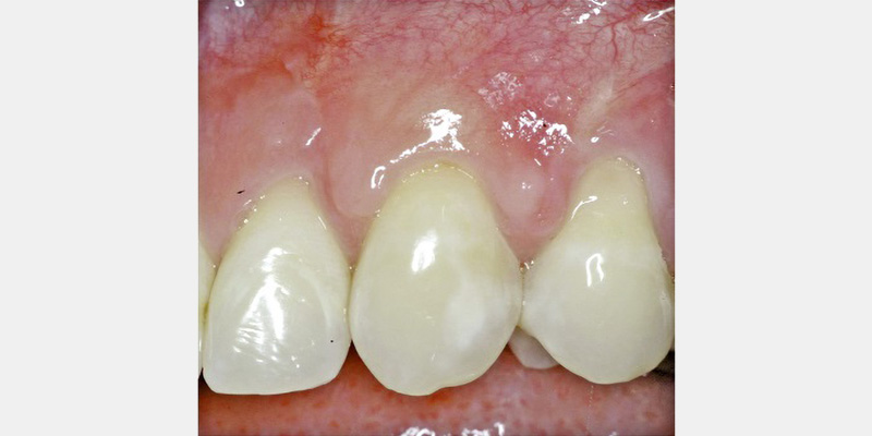 Modern Periodontal Regeneration: Advances in Tissue Engineering for Improved Clinical Outcomes EToddScheyer modern periodontal regeneration advances in tissue engineering for improved clinical outcomes Fig.3b