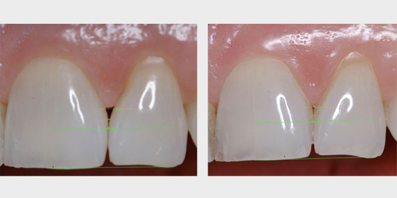 Modern Periodontal Regeneration: Advances in Tissue Engineering for Improved Clinical Outcomes EToddScheyer modern periodontal regeneration advances in tissue engineering for improved clinical outcomes Fig.4a 4b