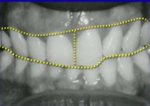 FRankSpear steps in the veneer seating process Fig.1