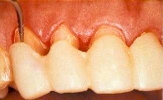 The Truth About Exceptional Veneer Temporaries Frank Spear The Truth About Exceptional Veneer Temporaries Featured Image