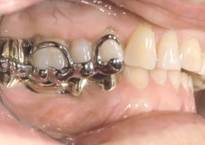 Tooth Wear Appliances: Posterior Pivots