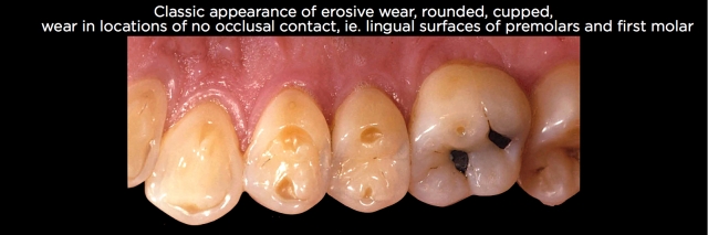 Where, Oh Where, Did That Tooth Wear Come From? Part 2 Frank Spear Where Oh Where Did That Tooth Wear Come From Part 2 Figure 1