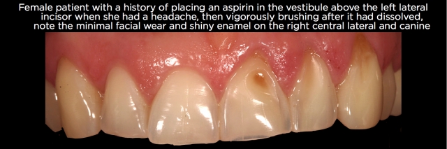 Where, Oh Where, Did That Tooth Wear Come From? Part 2 Frank Spear Where Oh Where Did That Tooth Wear Come From Part 2 Figure 10